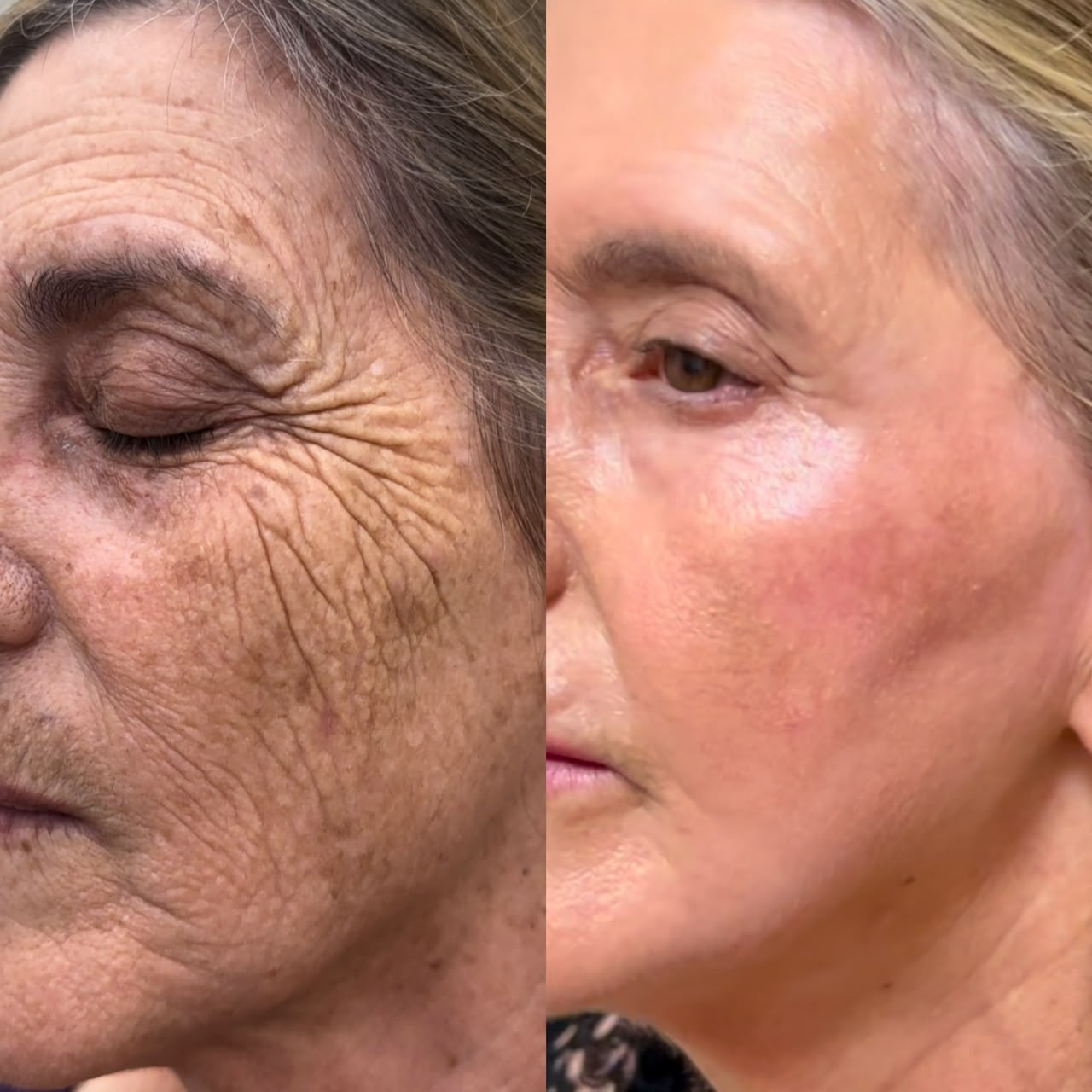Peeling ATA/Croton - Renovacao Profunda da Pele